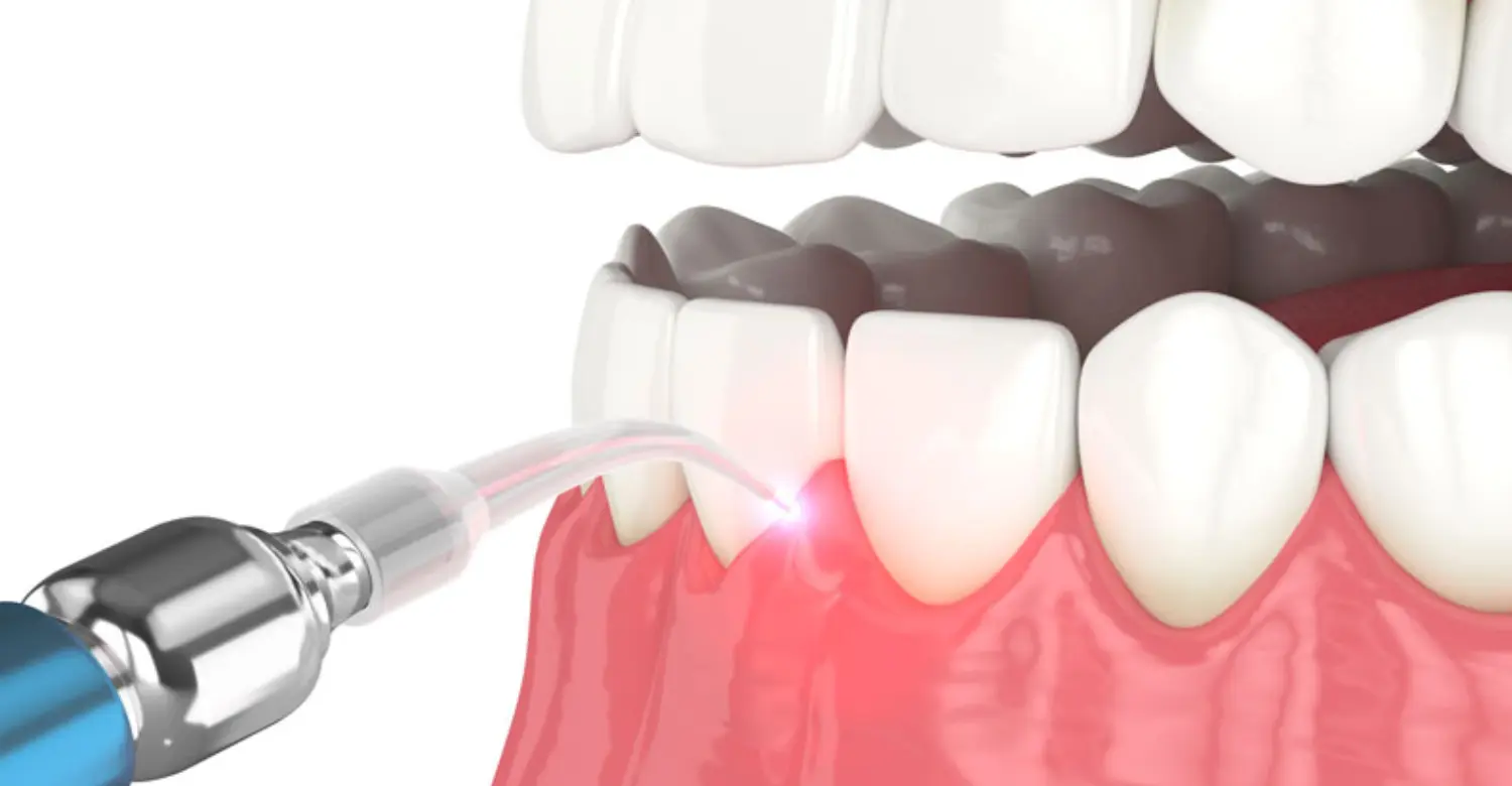 Laser Treatment for Gum Recession 2